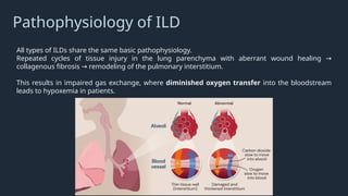 Interstitial Lung Disease Review and AE-ILD | PPTX