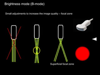 Brightness mode (B-mode)
Small adjustments to increase the image quality – focal zone
Superficial focal zone
 