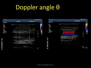 Doppler angle θ
kimbredahl79@gmail.com
 