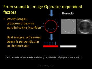 • Worst images:
ultrasound beam is
parallel to the interface
•
Best images: ultrasound
beam is perpendicular
to the interface
• interface
From sound to image Operator dependent
factors B-mode
Clear definition of the arterial walls is a good indication of perpendicular position.
kimbredahl79@gmail.com
 
