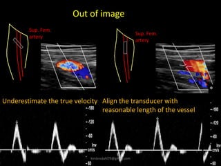 Sup. Fem.
artery
Sup. Fem.
artery
Underestimate the true velocity Align the transducer with
reasonable length of the vessel
Out of image
kimbredahl79@gmail.com
 