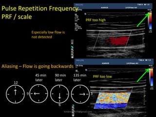6
PRF too high
PRF too low
Aliasing – Flow is going backwards
12
9 3
45 min
later
90 min
later
135 min
later
Pulse Repetition Frequency
PRF / scale
Especially low flow is
not detected
kimbredahl79@gmail.com
 