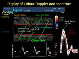 Display of Colour Doppler and spectrum
Colour
scale
Framerate
Angle θ
Doppler Angle θ
Beam path (Steer)
Colour Box
Doppler angle
Correction curser
Sample Volume
Distance
Peak systolic
velocity
Mean
velocity
kimbredahl79@gmail.com
 