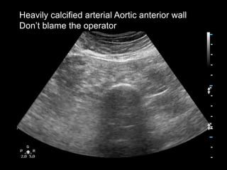 Heavily calcified arterial Aortic anterior wall
Don’t blame the operator
 