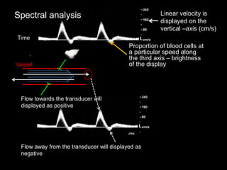 Spectral analysis
Flow towards the transducer will
displayed as positive
Flow away from the transducer will displayed as
negative
Time
Linear velocity is
displayed on the
vertical –axis (cm/s)
Proportion of blood cells at
a particular speed along
the third axis – brightness
of the display
Vessel
 