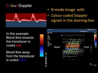 Heart Foot
In this example:
Blood flow towards
the transducer is
coded red
Blood flow away
from the transducer
is coded blue
Colour Doppler
• B-mode image with
• Colour coded Doppler
signals in the steering-box
 