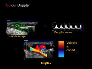 B-mode image
+
Doppler curve
=
Velocity
is
coded
Duplex
Colour Doppler
 