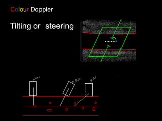 θ
Tilting or steering
Colour Doppler
 