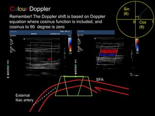 SFA
External
Iliac artery
Remember! The Doppler shift is based on Doppler
equation where cosinus function is included, and
cosinus to 90 degree is zero
Colour Doppler
1
Cos
(θ)
Sin
(θ)
0
 