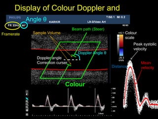 Display of Colour Doppler and
spectrum
Peak systolic
velocity
Mean
velocity
Framerate
Angle θ
Distance
Colour
scale
Beam path (Steer)
Colour
Box
Doppler angle
Correction curser
Doppler Angle θ
Sample Volume
 