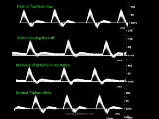 Normal Triphasic flow
After releasing the cuff
Normal Triphasic flow
Recovery of peripheral resistance
kimbredahl79@gmail.com
 
