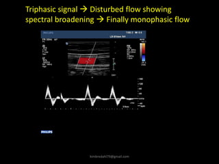Triphasic signal → Disturbed flow showing
spectral broadening → Finally monophasic flow
kimbredahl79@gmail.com
 