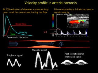 x3
Velocity profile in arterial stenosis
Stenotic signal
Post-stenotic signal
Monofasic signal
Tri-phasic signal
Blood flow
Velocity
Decrease in diameter
50%
At 70% reduction of diameter a pressure drop
occur - and the stenosis are limiting the flow
This correspond to a 2-3 fold increase in
systolic velocity
kimbredahl79@gmail.com
 