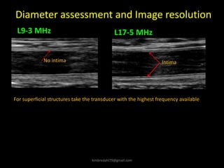 Diameter assessment and Image resolution
L9-3 MHz L17-5 MHz
Intima
No intima
For superficial structures take the transducer with the highest frequency available
kimbredahl79@gmail.com
 