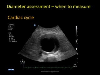 Diameter assessment – when to measure
Cardiac cycle
kimbredahl79@gmail.com
 
