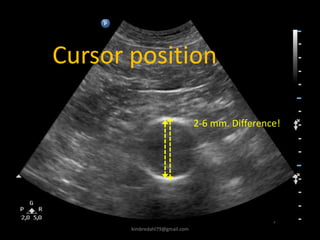 Cursor position
2-6 mm. Difference!
kimbredahl79@gmail.com
 