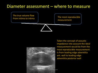 Diameter assessment – where to measure
Taken the concept of acoustic
impedance into account the ideal
measurement would be from the
most reproducible measurement
is from leading edge adventitia
ant. wall to leading edge
adventitia posterior wall
The most reproducible
measurement
The true volume flow
From intima to intima
kimbredahl79@gmail.com
 
