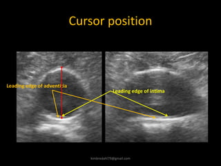Cursor position
Leading edge of intima
Leading edge of adventitia
kimbredahl79@gmail.com
 