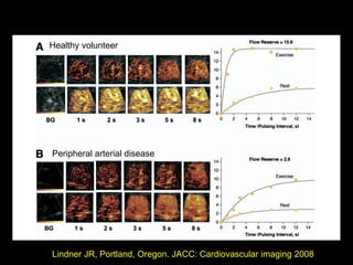 Peripheral arterial disease
Healthy volunteer
Lindner JR, Portland, Oregon. JACC: Cardiovascular imaging 2008
 