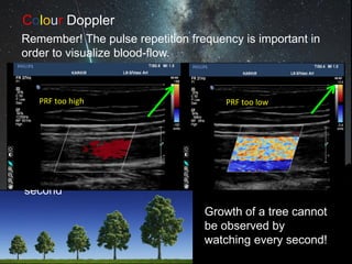Colour Doppler
Remember! The pulse repetition frequency is important in
order to visualize blood-flow.
Growth of a tree cannot
be observed by
watching every second!
If the speed is high – you have to watch every
second
Low
flow
PRF too high PRF too low
 
