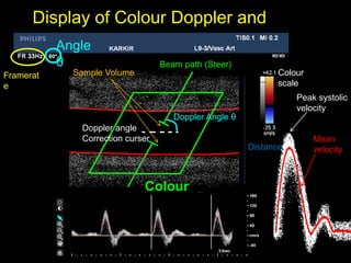 Display of Colour Doppler and
spectrum
Peak systolic
velocity
Mean
velocity
Framerat
e
Angle
θ
Distance
Colour
scale
Beam path (Steer)
Colour
Box
Doppler angle
Correction curser
Doppler Angle θ
Sample Volume
 