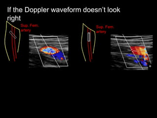 Sup. Fem.
artery
Sup. Fem.
artery
If the Doppler waveform doesn’t look
right
 