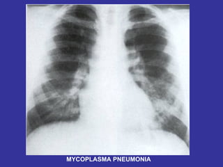 MYCOPLASMA PNEUMONIA 