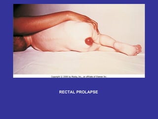 RECTAL PROLAPSE 