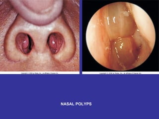 NASAL POLYPS 