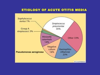 Pseudomonas aeroginosa ETIOLOGY OF ACUTE OTITIS MEDIA 
