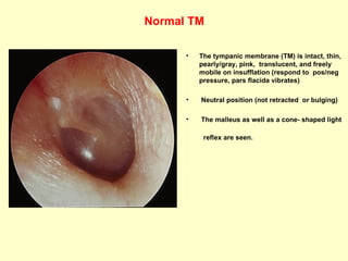 Normal TM The tympanic membrane (TM) is intact, thin, pearly/gray, pink,  translucent, and freely mobile on insufflation (respond to  pos/neg pressure,  pars flacida vibrates) Neutral position (not retracted  or bulging) The malleus as well as a cone- shaped light  reflex are seen. 
