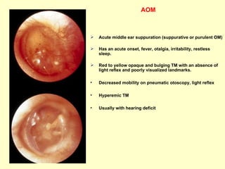 AOM Acute middle ear suppuration (suppurative or purulent OM)  Has an acute onset, fever, otalgia, irritability, restless sleep. Red to yellow opaque and bulging TM with an absence of light reflex and poorly visualized landmarks. Decreased mobility on pneumatic otoscopy, light reflex Hyperemic TM Usually with hearing deficit  