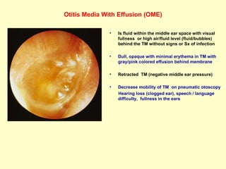 Otitis Media With Effusion (OME) Is fluid within the middle ear space with visual fullness  or high air/fluid level (fluid/bubbles) behind the TM without signs or Sx of infection  Dull, opaque with minimal erythema in TM with gray/pink colored effusion behind membrane  Retracted  TM (negative middle ear pressure)  Decrease mobility of TM  on pneumatic otoscopy Hearing loss (clogged ear), speech / language difficulty,  fullness in the ears  