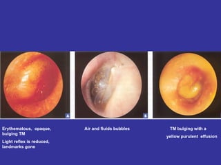 Erythematous,  opaque, bulging TM Light reflex is reduced, landmarks gone Air and fluids bubbles  TM bulging with a  yellow purulent  effusion  