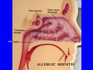 POS ALLERGIC  RHINITIS 