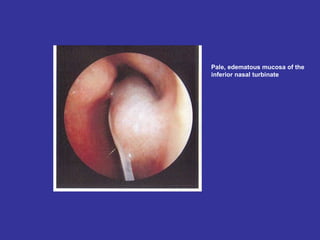 Pale, edematous mucosa of the inferior nasal turbinate 