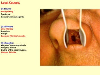 Local Causes : [1] Trauma Nose picking   Fractures. Caustic/chemical agents [2] Infections Viral Rhinitis Parasites  Fungal Bacterial Rhinitis/sinusitis [3] Idiopathic: Wegener's granulomatosis  Atrophic rhinitis Drying of the nasal mucosa Allergic Rhinitis 