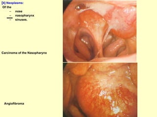 [ 4]   Neoplasms: Of the nose nasopharynx  sinuses. Angiofibroma Carcinoma of the Nasopharynx 
