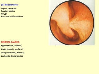 [ 5]  Miscellaneous:   Septal  deviation Foreign bodies Polyps Vascular malformations GENERAL CAUSES:   Hypertension, alcohol,  drugs (aspirin, warfarin) Coagulopathies, Anemia,  Leukemia, Malignancies 