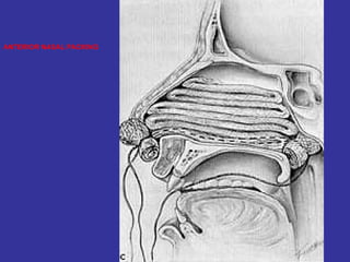 ANTERIOR NASAL PACKING 