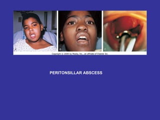 PERITONSILLAR ABSCESS 