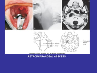 RETROPHARANGEAL ABSCESS 