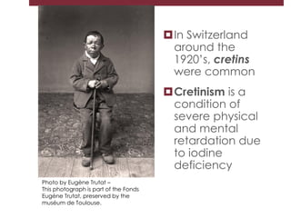 Photo by Eugène Trutat –
This photograph is part of the Fonds
Eugène Trutat, preserved by the
muséum de Toulouse.
In Switzerland
around the
1920’s, cretins
were common
Cretinism is a
condition of
severe physical
and mental
retardation due
to iodine
deficiency
 