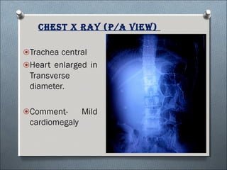 Chest X ray (p/a View)
 