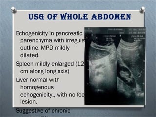 usG of whole abdomen
Echogenicity in pancreatic
parenchyma with irregular
outline. MPD mildly
dilated.
Spleen mildly enlarged (12.8
cm along long axis)
Liver normal with
homogenous
echogenicity., with no focal
lesion.
Suggestive of chronic
 