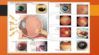 Presentation - Ocular Trauma.- injury to eye | PPTX