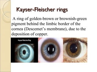 Kayser-Fleischer rings
 A ring of golden-brown or brownish-green
pigment behind the limbic border of the
cornea (Descemet’s membrane), due to the
deposition of copper.
 
