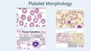 Presentation - PERIPHERAL BLOOD SMEAR AND MORPHOLOGICAL EVALUATION OF ...