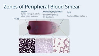 Presentation - PERIPHERAL BLOOD SMEAR AND MORPHOLOGICAL EVALUATION OF ...