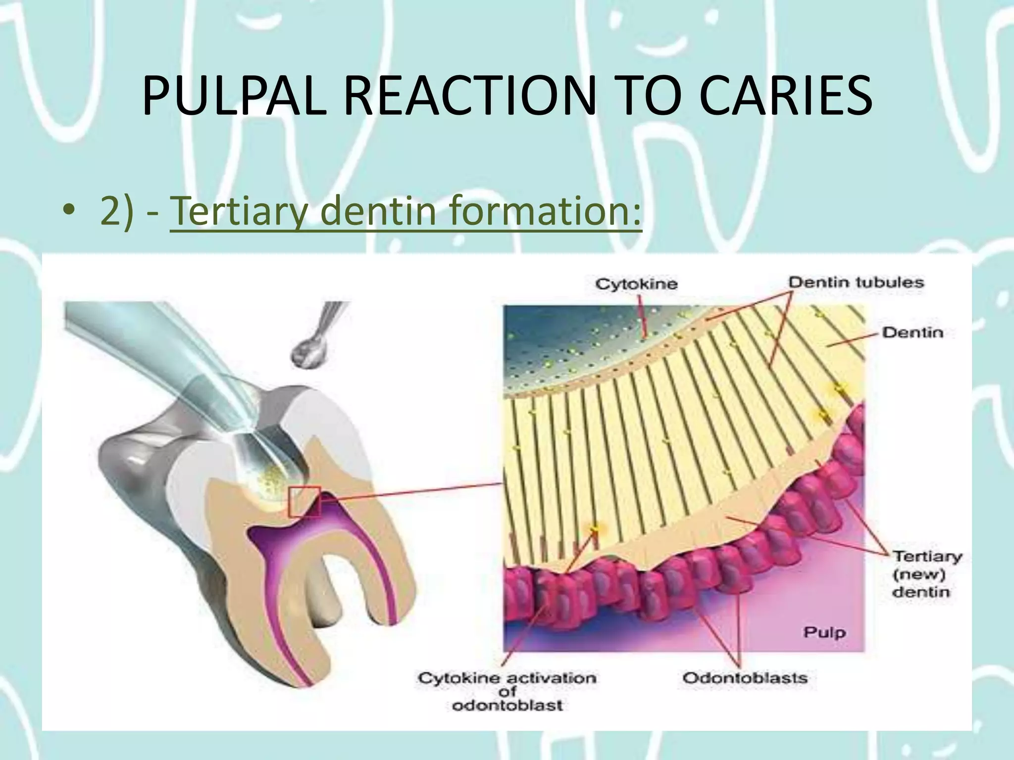 Pulp Caries Pulpal Reactions to Dental Caries and Dental Proceudres | PPTX